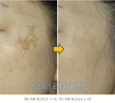 흑자 기미 레이저부작용 색소침착 원인은 듀얼토닝치료사례(레이저토닝+피코토닝) (6).png