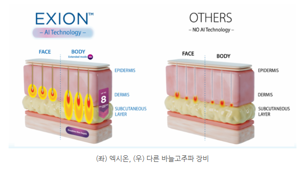 엑시온리프팅 흉터치료 (4).png