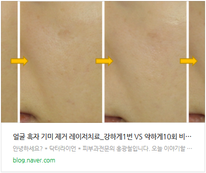 흑자 제거 레이저치료과정 1(리팟레이저 실패사례 해결) (8).png