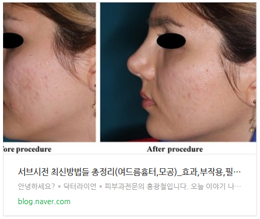 여드름흉터250502 (3).jpg