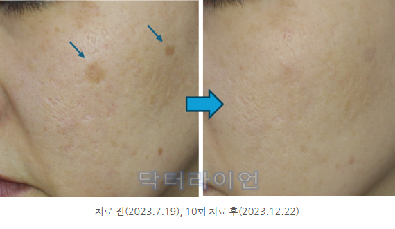 흑자 저출력레이저 과정 (6).jpg
