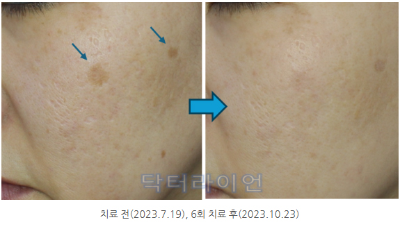 흑자 치료과정 후기 2편 (2).jpg