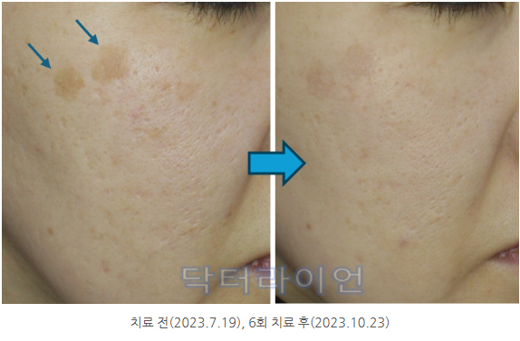 흑자 치료과정 후기 2편 (3).jpg