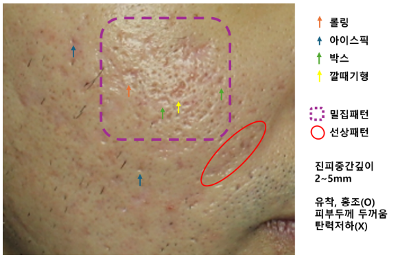 여드름흉터 종류 (6).png