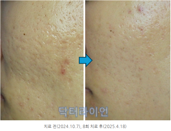 롤링흉터 박스흉터 여드름흉터 (8).png