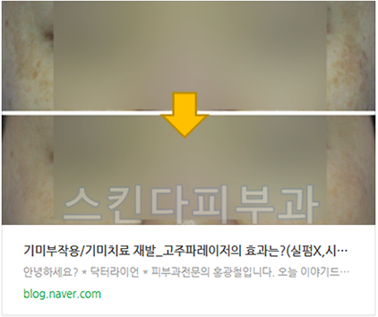 기미 흑자 오타모반 레이저치료 10가지 방법 총정리&비교(치료사례전후) (12).png