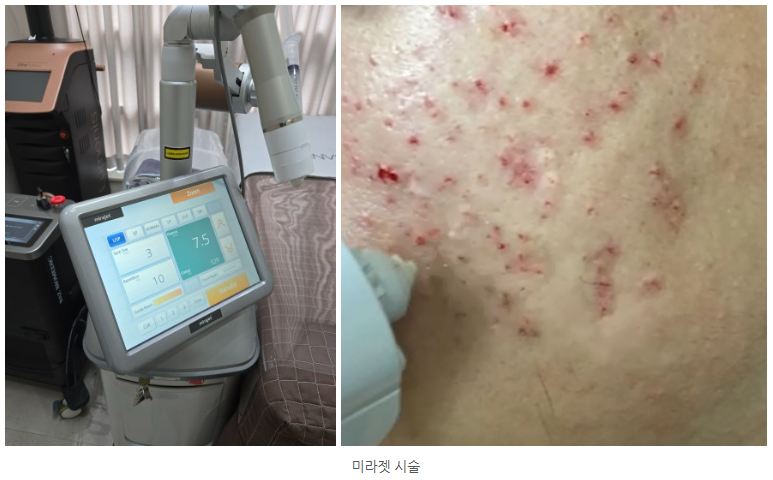 울트라펄스알파 여드름흉터 (10).png