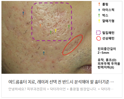 울트라펄스알파 여드름흉터 (4).png