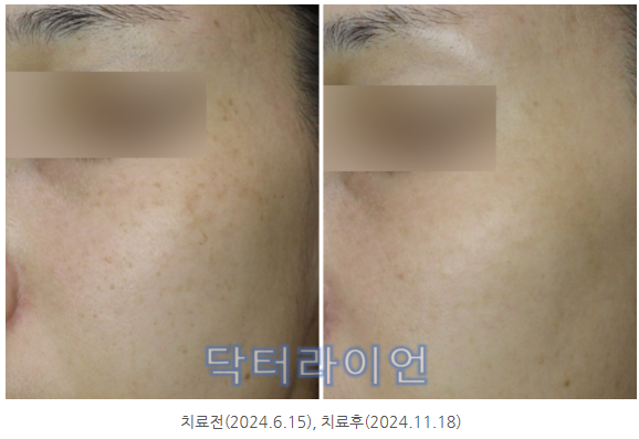 기미종류 (8).png
