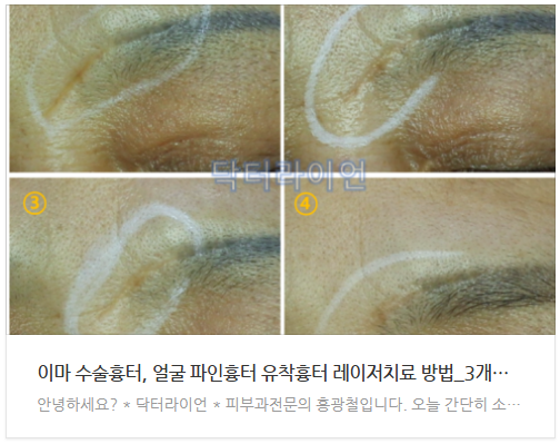 얼굴 이마 미간 콧잔등 수술흉터 (6).png