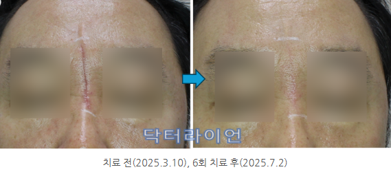 얼굴 이마 미간 콧잔등 수술흉터 (2).png