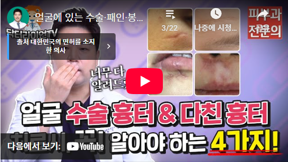 얼굴 이마 미간 콧잔등 수술흉터 (9).png
