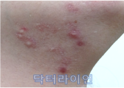 턱밑·턱선 울퉁불퉁한 흉터 (1).png