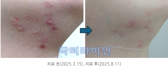 턱밑·턱선 울퉁불퉁한 흉터 (6).png