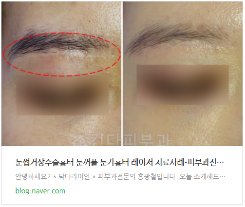 눈썹거상흉터 부작용 (2).png