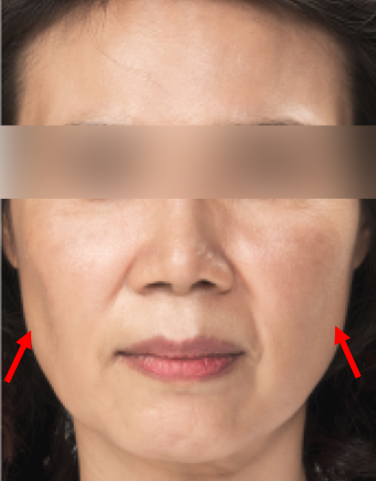 사각턱보톡스 볼패임 부작용 예방하는 방법 (5).png