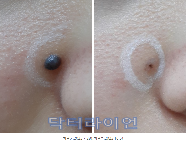 선천성모반 (5).png