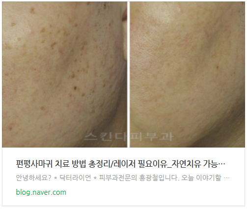 강남 청담 편평사마귀 듀오덤 (11).jpg