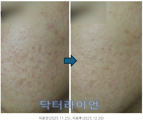 리투오 쥬브아셀 여드름흉터 모공 (9).png