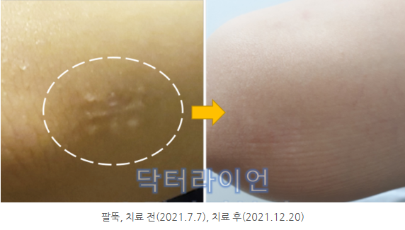 지방흡입흉터 제거 레이저 (14).png