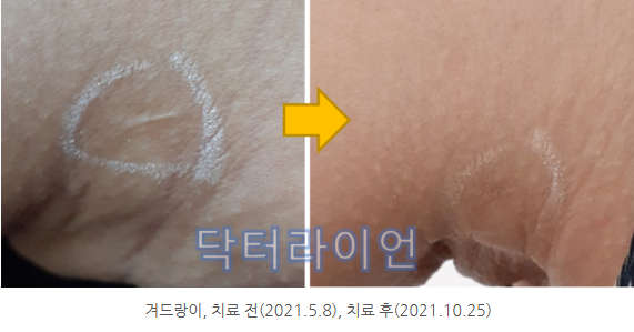 지방흡입흉터 제거 레이저 (3).png