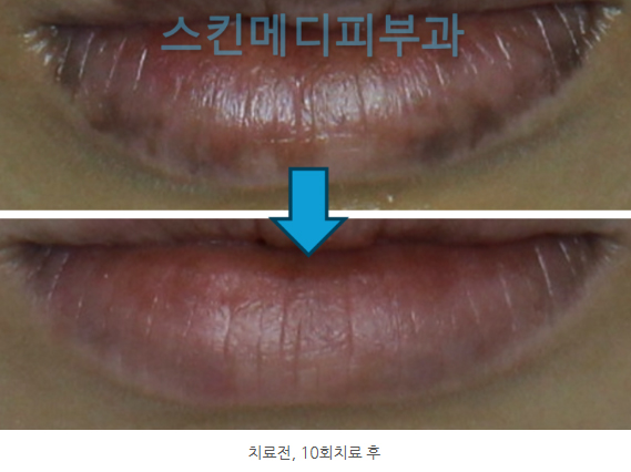 입술색소침착 vs 입술흑자 제거 (4).jpg