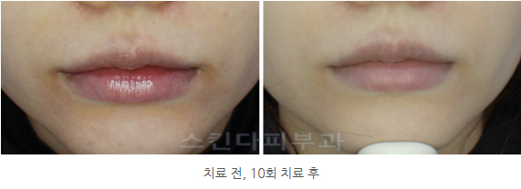 입술색소침착 vs 입술흑자 제거 (2).jpg