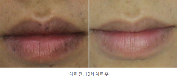 입술색소침착 vs 입술흑자 제거 (1).jpg