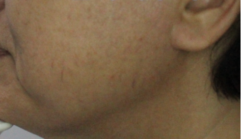 써마지 볼처짐 효과  (10).png