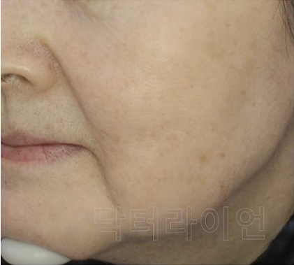 써마지 볼처짐 효과  (12).png