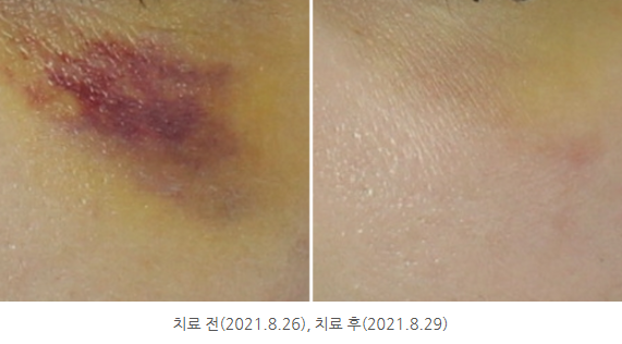 멍레이저 (7).png