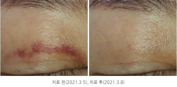 멍레이저 (10).png