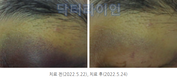 멍레이저 (9).png