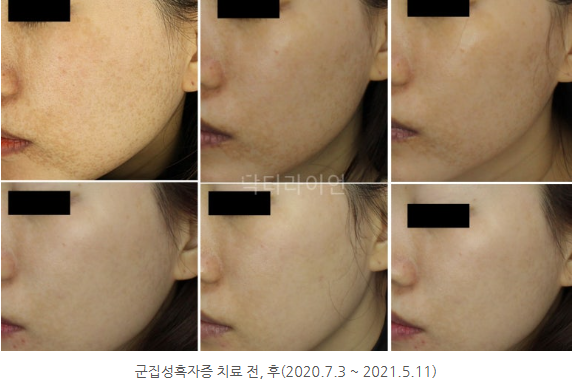 얼굴흑자제거 (6).png