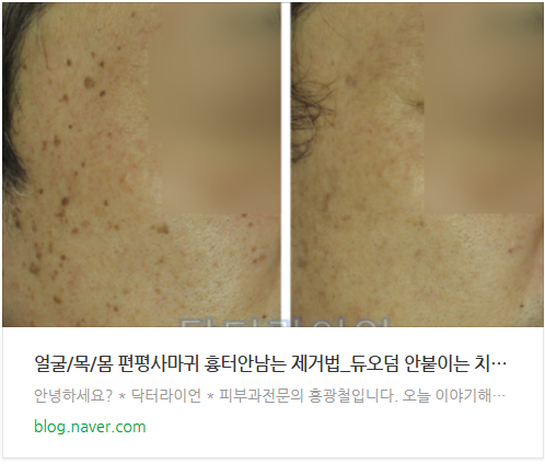 슴 배 편평사마귀 제거_약물.면역치료 효과 분석 (7).png