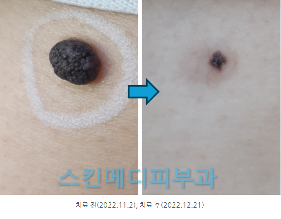 선천성모반 (10).jpg