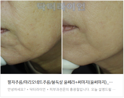 팔자주름 추천 시술 (5).png