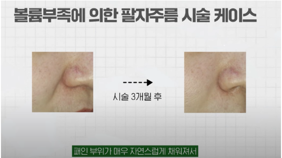 팔자주름 추천 시술 (14).png