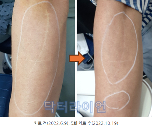 팔흉터 수술흉터 봉합흉터 다친흉터제거 레이저 치료 (3).jpg