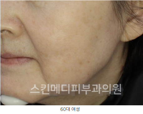 울쎄라 써마지 FLX 300샷 600샷 900샷 나에게 필요한 샷수 아는방법 (5).png