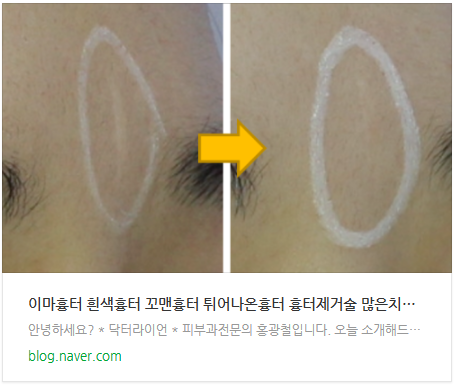 이마 수술흉터, 얼굴 파인흉터 유착흉터 레이저치료 방법_3개월 경과 후기 (15).png