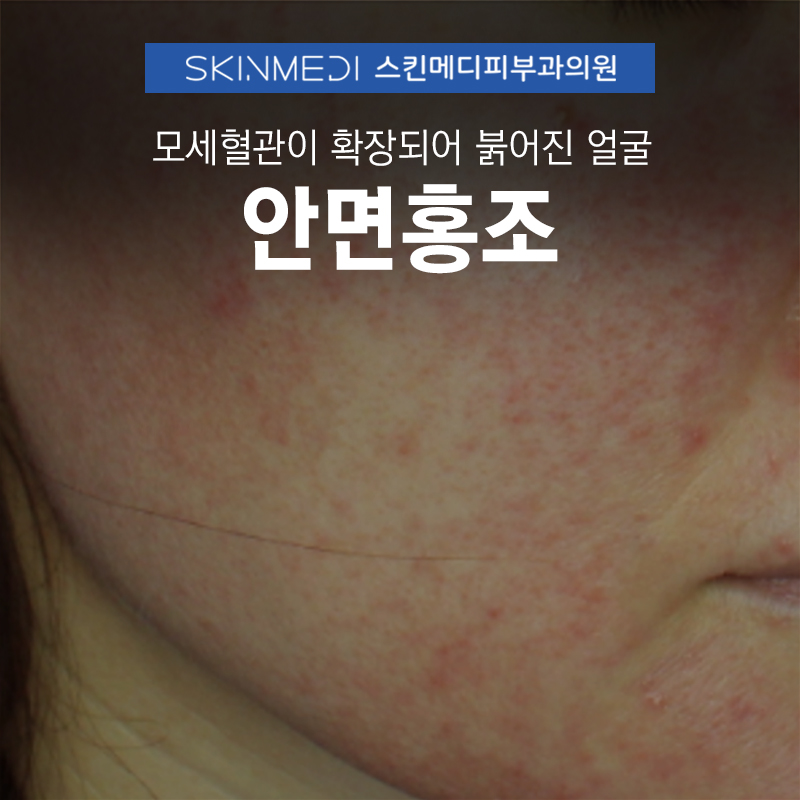 안면홍조 모세혈관확장증 (1).jpg