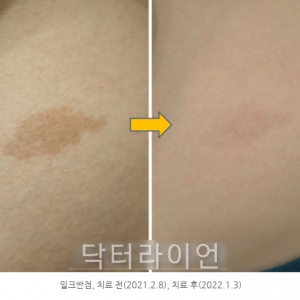 밀크반점(카페오레반점)/베커모반_저출력레이저 vs 루비레이저 치료 비교분석(치료전후사례)