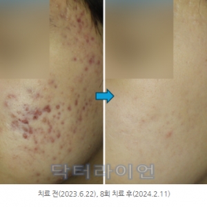 강남청담 화농성여드름/붉은자국/패인흉터 동시에 레이저치료법_오푸스(레가토)+브이빔퍼펙타