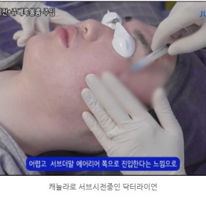 여드름흉터 서브시전+쥬베룩볼륨(롤링흉터,박스흉터)_시술법 공개!9실제 시술 영상 1편)