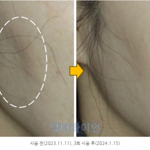 강남 청담 쥬베룩볼륨 1병은 몇cc? 부위별 용량 총정리(팔자,옆볼,눈밑)_피부과전문의