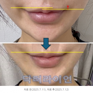 엠페이스 리프팅 얼굴안면 비대칭, 입꼬리비대칭 교정_*효과분석 후기