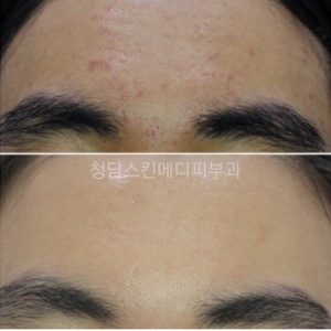 청담쥬베룩 여드름흉터 치료 후기로 알아보는 효과