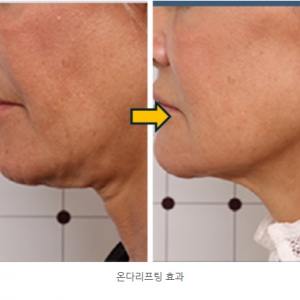 온다리프팅vs울쎄라vs인모드_이중턱,심부볼,볼처짐 *효과비교 및 장단점*