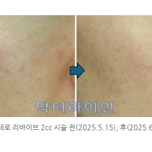 벨로테로리바이브 vs 리쥬란 vs 쥬베룩 vs 레디어스_효과 선택기준 비교분석(스킨부스터 1만 케이스)